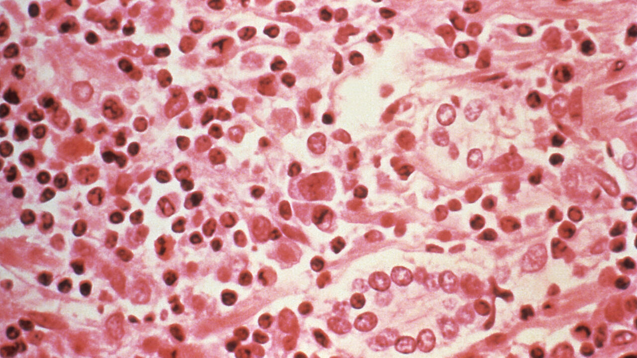 What is hantavirus, the illness suspected to have killed several people on an Atlantic cruise ship?